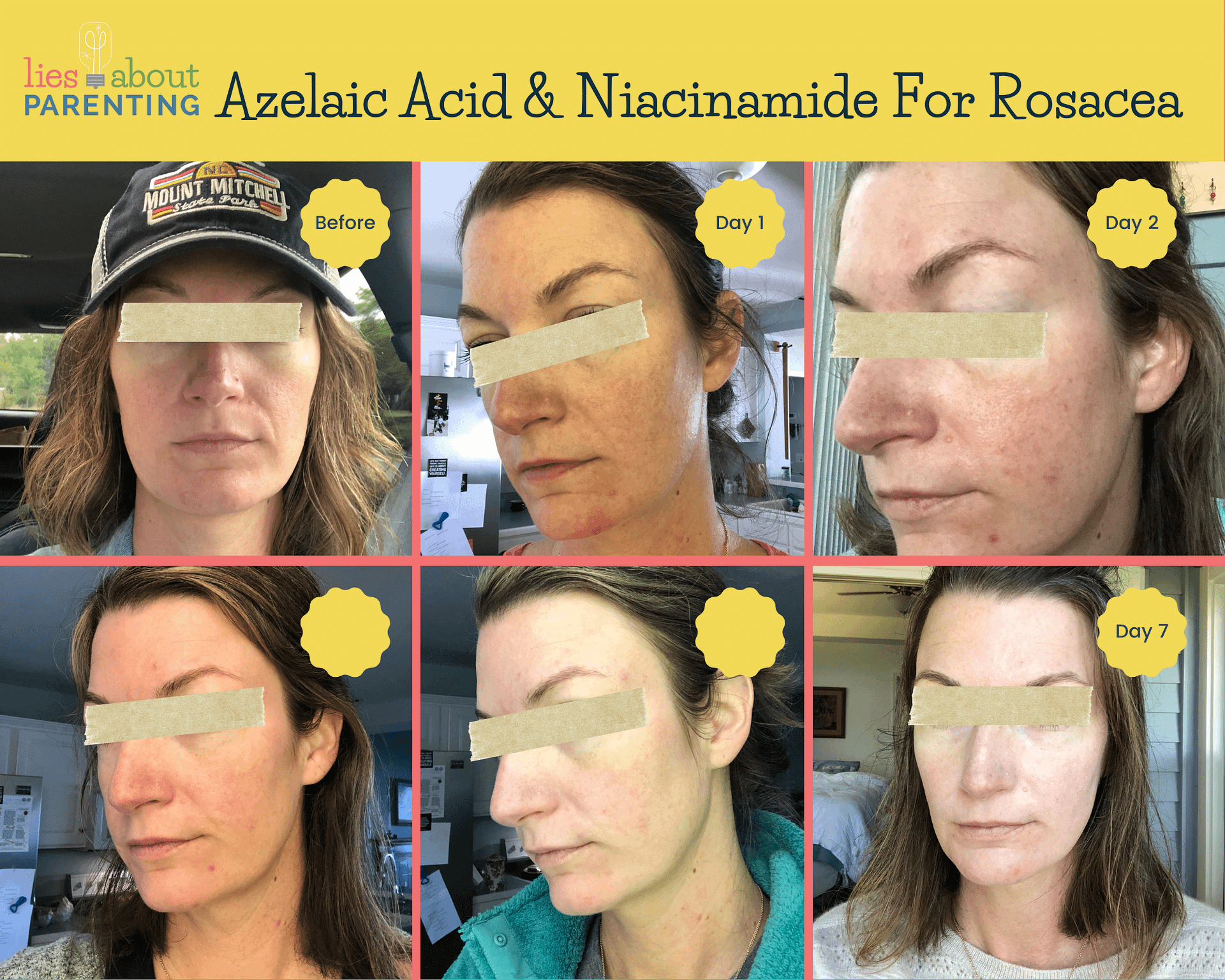 Before and after pictures Azelaic Acid to treat rosacea caused by mites